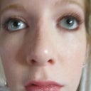 3 months after surgery. Bump visible
