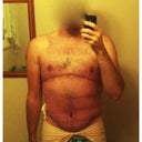Photo taken 8 weeks post-360 body lift, and 2 weeks post chest reduction and inner thigh lift.