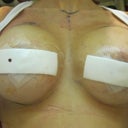 hours after surgery