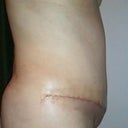 3 weeks Pos Op - side View...you can tell more of the swelling on the side view