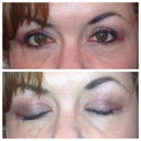 Day 66 post surgery. Getting better every day. One eye is red where I rubbed it due to spring Allergies.