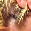 Scars where the hair never grew back