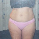  1 day before SmartLipo