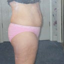  1 day before SmartLipo