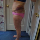 5 days after SmartLipo