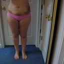 5 days after SmartLipo