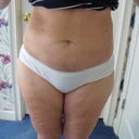 22 days after SmartLipo