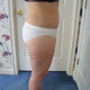 22 days after SmartLipo
