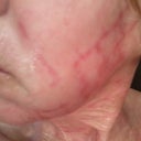 Cheek day five...red marks have blisters dotted through out