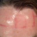 Forehead same as cheeks