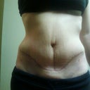 7wks post op and 11 lbs weight loss