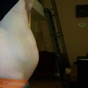 this was before the surgery