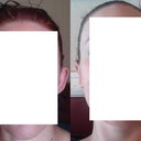 I feel weird putting my face on the internet, but at least you can see my original ears and the finished product from Dr. Horndeski.  The first surgeon did basically nothing.  Dr. Horndeski took my ears inward significantly, made them more equal, and made them look how I wanted them to.  Thank you so much!!