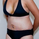 Day 5 post op. I still have stretch marks because my original stretch marks were way above my bb.