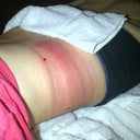 Immediately after the first side was treated.  Ouch.... Not so fast!  I had an hr on the other side yet!!