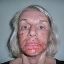 Swollen and lots of ointments...looking ugly!
12 hrs after procedure, no pain, still droozy
