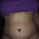4 weeks PO/incission looks darkers due to an antibacterial lotion