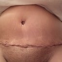 PO Day 4 - pretty pleased so far - waiting for the swelling to come down!
