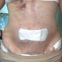 After Day 1 Stomach
