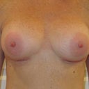 Front ~1 Day Post-Op