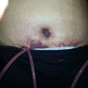 post opt day 2