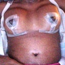 Very swollen tummy...looks bigger than my before pic but stretch marks are mostly gone.