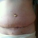 Little muffin top, hopefully mostly swelling.