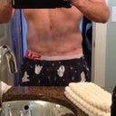 POST OP DAY 25 - SCAR