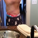 POST OP DAY 25 - Side 2