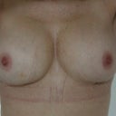 almost 2 weeks post surgery- looking much better
