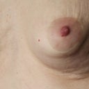 One year results after Breform uplift