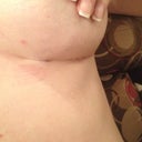 breast incisions healing very nicely.  No more dressings and not bras for now, just that dad gum strap of doom!