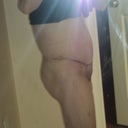 Right side 9 days post op. No overhanging skin! YEAH!