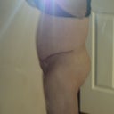 Left side 9 days post op. The apron is GONE! WooHoo!