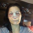 Day 2 (1 day post op)- let the bruising begin.