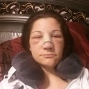 Day 3 (2 days post op)- I previously read another post and they said that day 3 was the worst...I think I might have to agree. But all in all, it wasn't that bad.