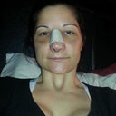 Day 5 (4 days post op)- bandage removed and felt great.