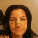 Day 6 (5 days post op)- my face just kept getting rounder and rounder as the bruising faded. It was really kinda weird.