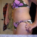 3 week post op side view