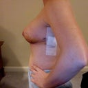 Post op 9 days. Drains removed today.