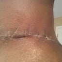 PO Day 21 - Incision still has some tension marks but they are becoming less aparent over time as the stomach stretches.