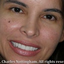 Gummy Smile Correction