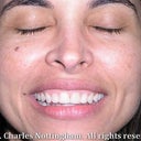 Gummy Smile Correction