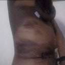 bruising and swelling at po day 6 side view