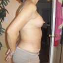 5 weeks post op, still swollen but  better