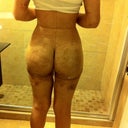 2 days post op