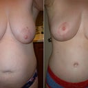 Before and after- 6 months PO