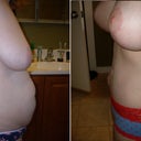 Before and after side shot- 6 months PO. You can really see the difference here.