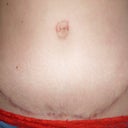Tummy tuck scar- 6 months PO