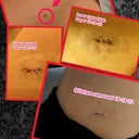 My Dermafibroma removal. I have 3 total, but this is just 1. I am so happy she removed these. I hated them. The area is very irritated from wearing waterproof bandaids & last WP bandaid I wore was by Bandaid brand & it removed skin....ouch! So a lot of what u see is skin irritation.